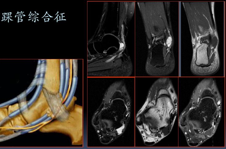 踝关节常见病变的MRI表现 踝关节常见病变的MRI表现
