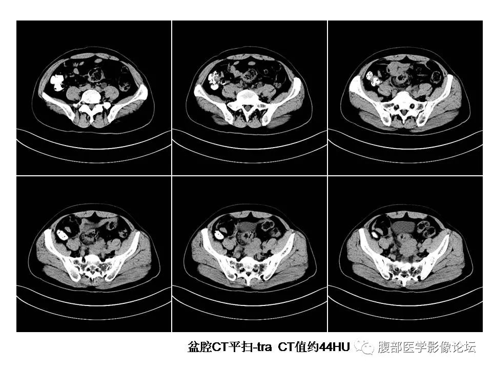 【病例】直肠乙状结肠交界处神经内分泌癌1例CT影像表现
