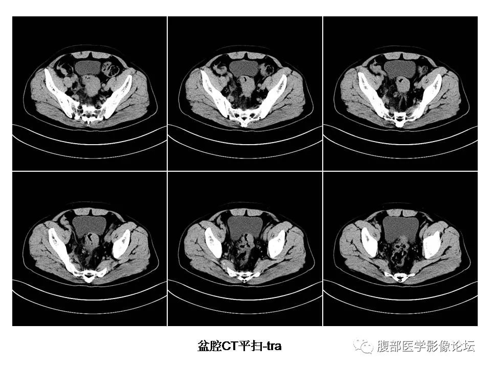【病例】直肠乙状结肠交界处神经内分泌癌1例CT影像表现