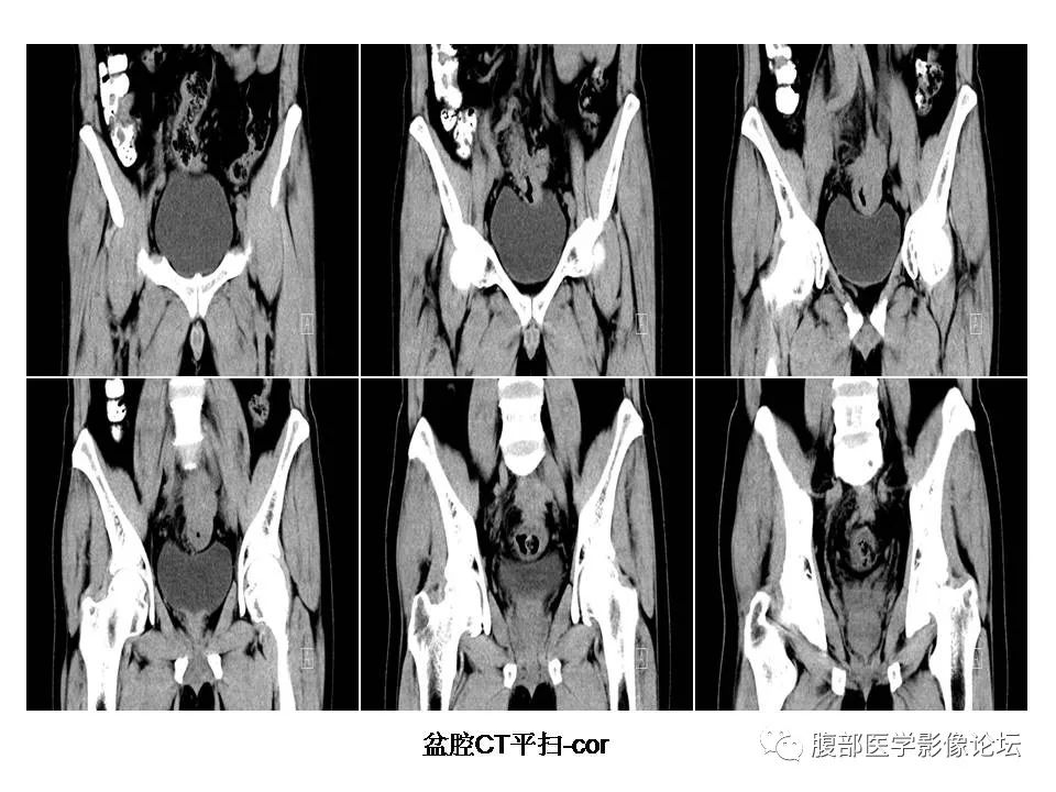 【病例】直肠乙状结肠交界处神经内分泌癌1例CT影像表现