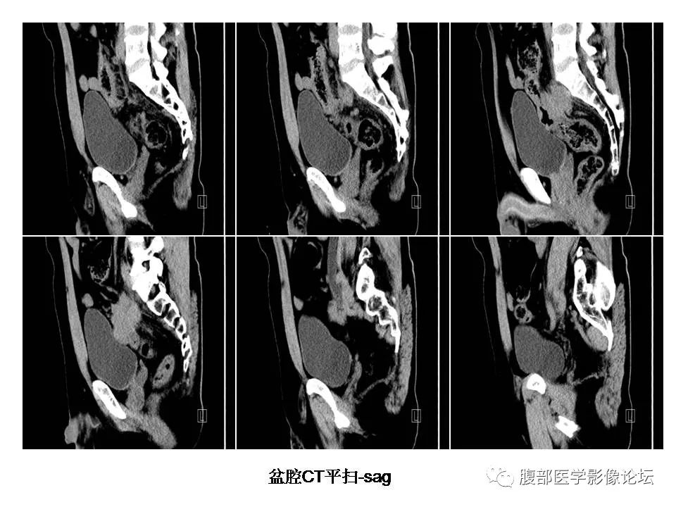 【病例】直肠乙状结肠交界处神经内分泌癌1例CT影像表现