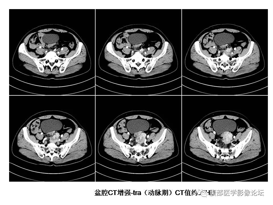 【病例】直肠乙状结肠交界处神经内分泌癌1例CT影像表现