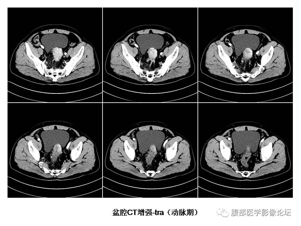 【病例】直肠乙状结肠交界处神经内分泌癌1例CT影像表现