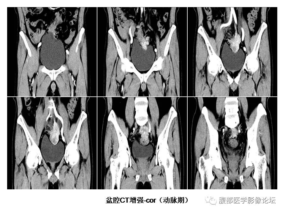 【病例】直肠乙状结肠交界处神经内分泌癌1例CT影像表现