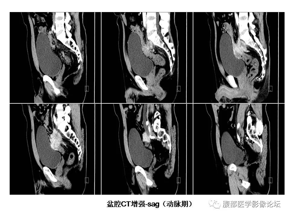 【病例】直肠乙状结肠交界处神经内分泌癌1例CT影像表现