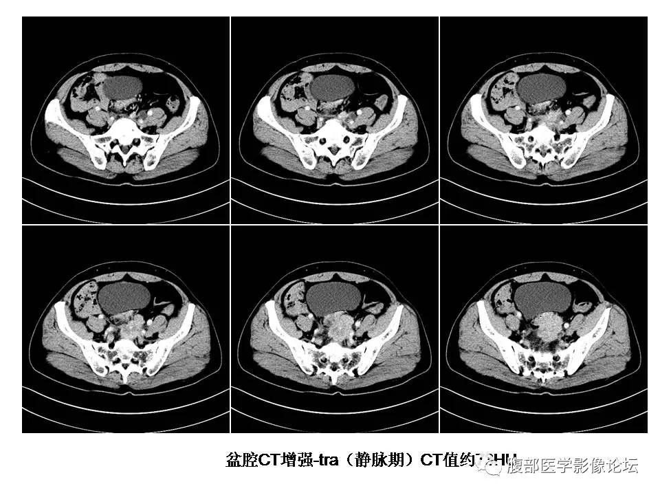 【病例】直肠乙状结肠交界处神经内分泌癌1例CT影像表现
