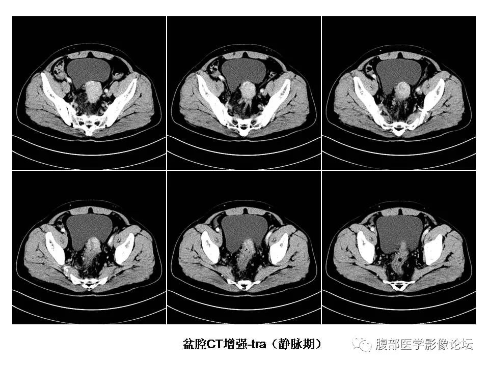 【病例】直肠乙状结肠交界处神经内分泌癌1例CT影像表现