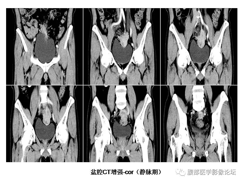 【病例】直肠乙状结肠交界处神经内分泌癌1例CT影像表现