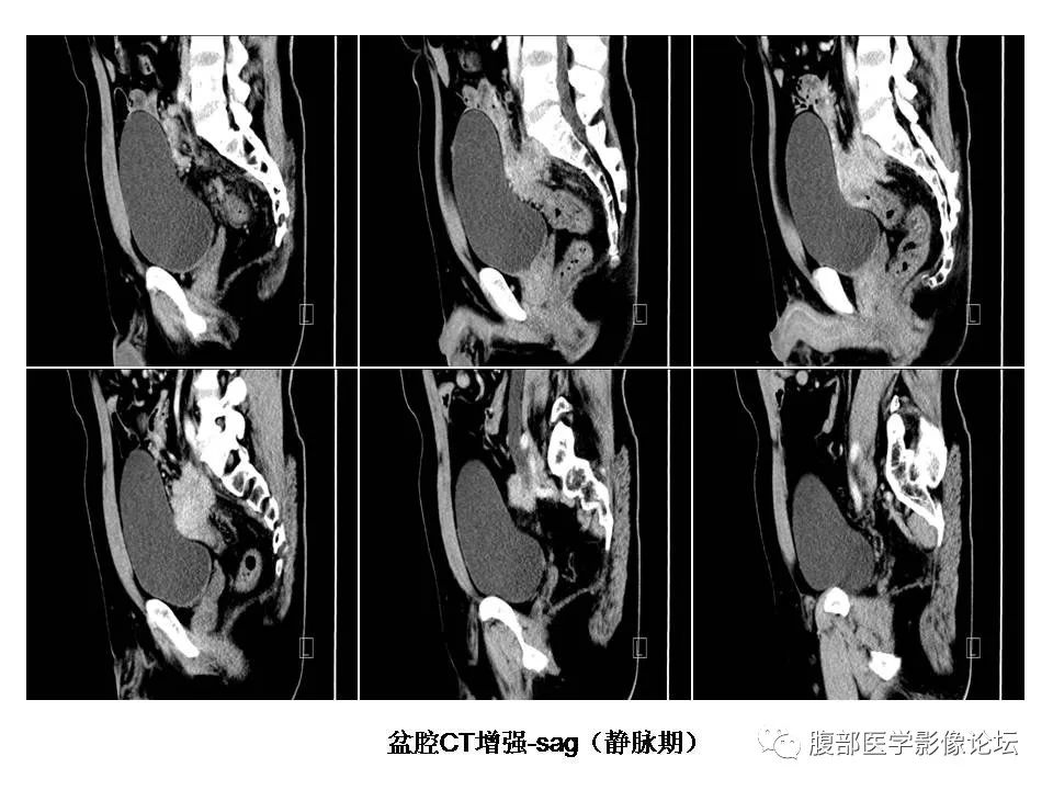 【病例】直肠乙状结肠交界处神经内分泌癌1例CT影像表现