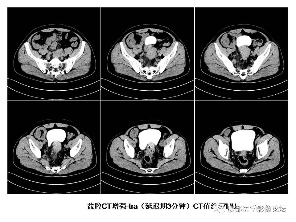 【病例】直肠乙状结肠交界处神经内分泌癌1例CT影像表现