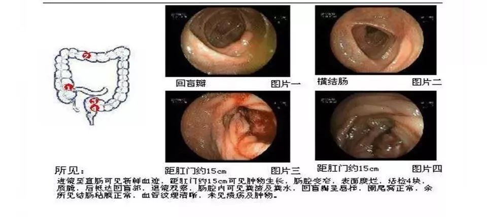 【病例】直肠乙状结肠交界处神经内分泌癌1例CT影像表现