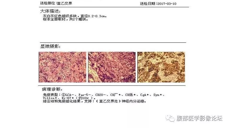 【病例】直肠乙状结肠交界处神经内分泌癌1例CT影像表现