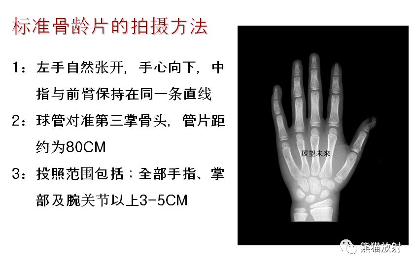 骨龄图谱 骨龄图谱