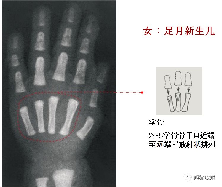 骨龄图谱 骨龄图谱