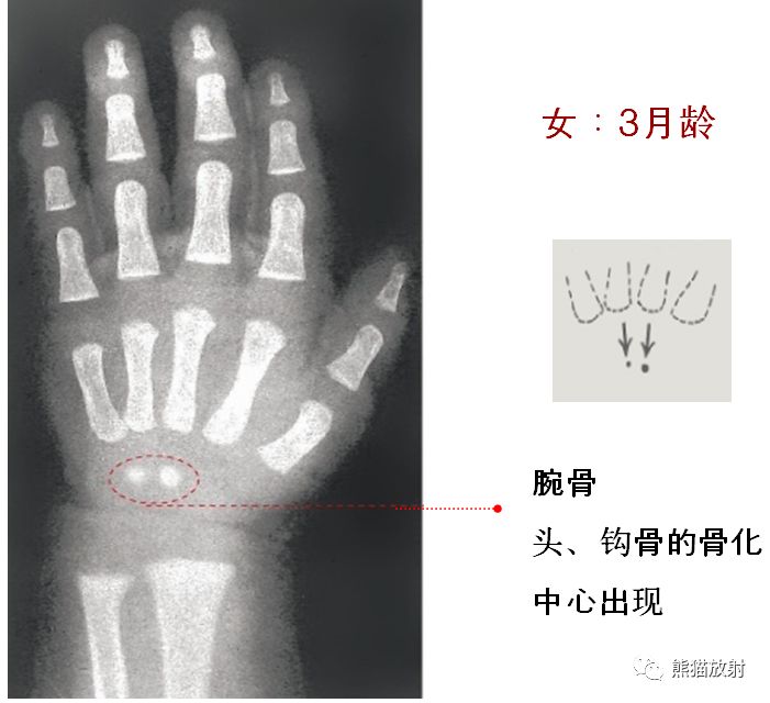 骨龄图谱 骨龄图谱