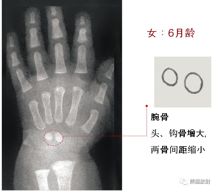 骨龄图谱 骨龄图谱