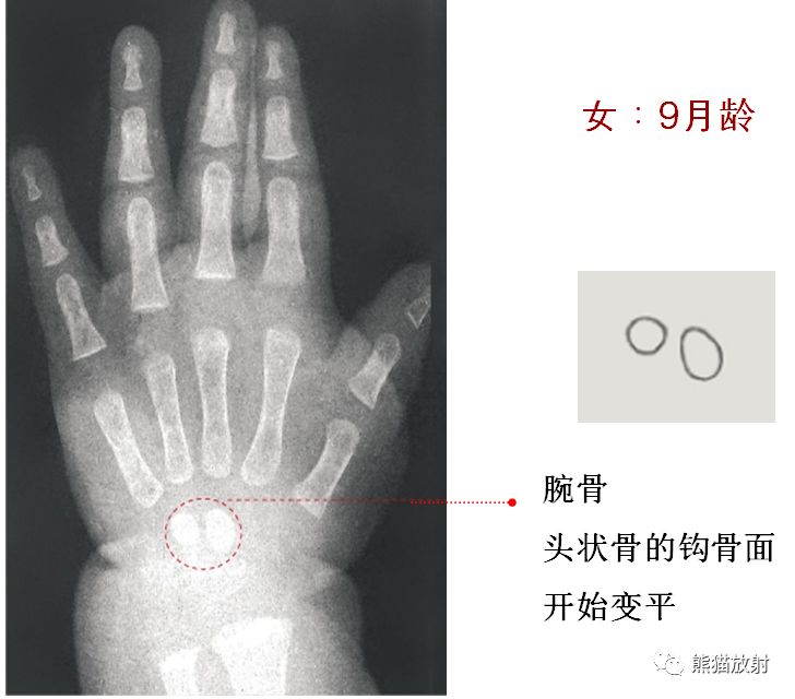 骨龄图谱 骨龄图谱