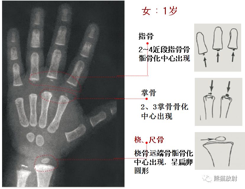 骨龄图谱 骨龄图谱