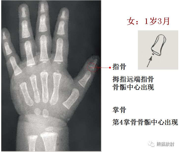 骨龄图谱 骨龄图谱