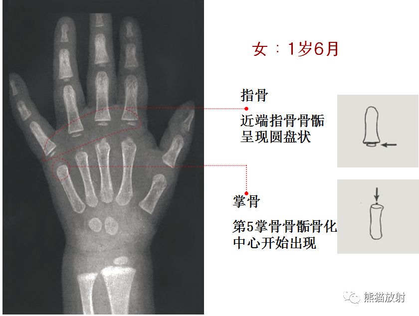 骨龄图谱 骨龄图谱