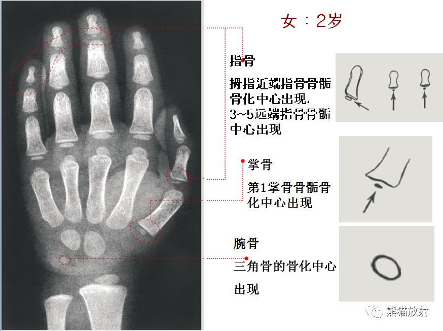 骨龄图谱 骨龄图谱