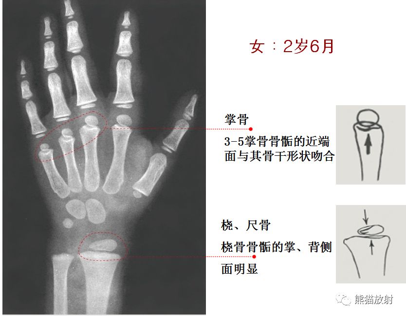 骨龄图谱 骨龄图谱