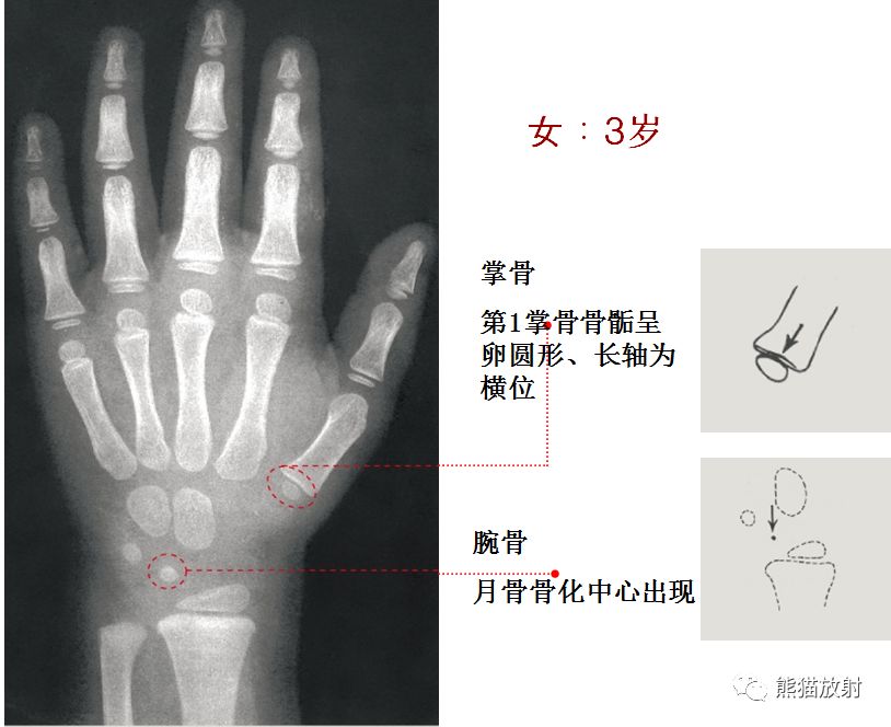 骨龄图谱 骨龄图谱