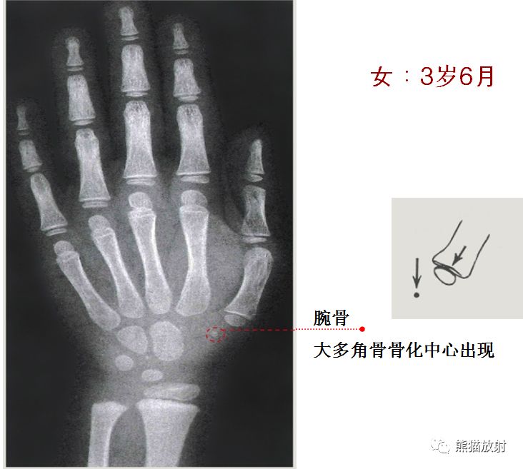 骨龄图谱 骨龄图谱