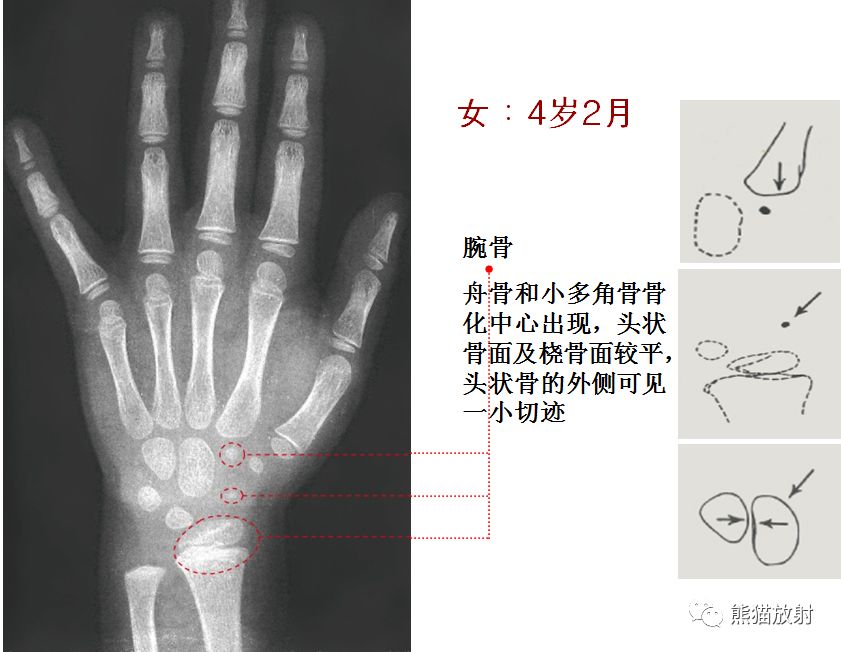 骨龄图谱 骨龄图谱