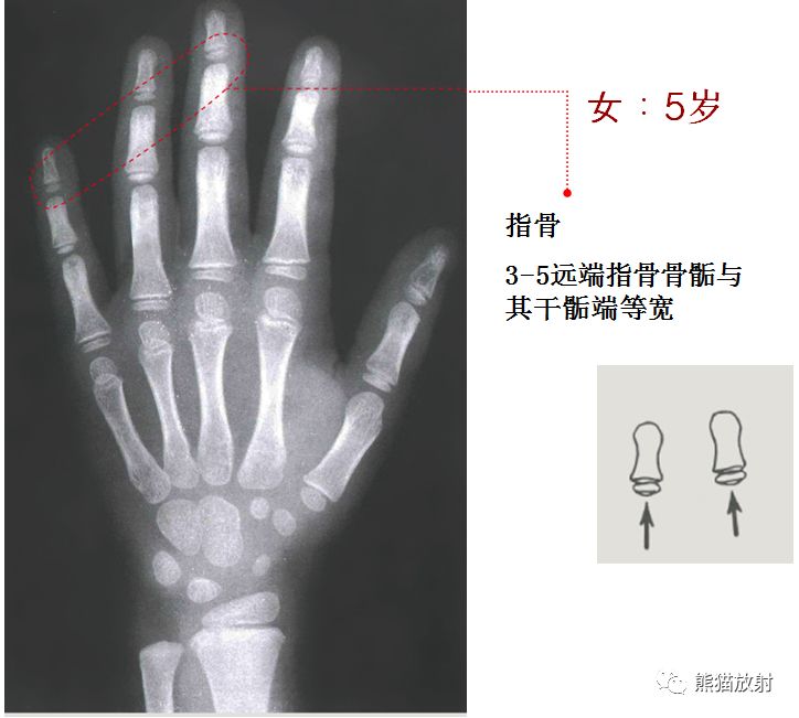 骨龄图谱 骨龄图谱