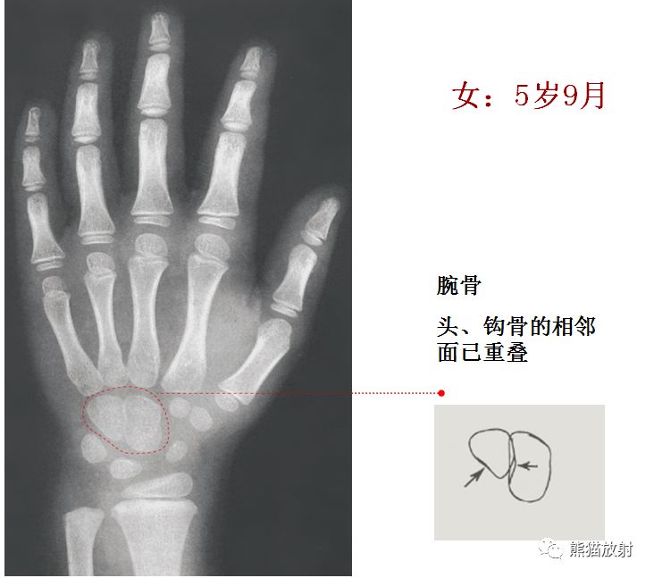 骨龄图谱 骨龄图谱