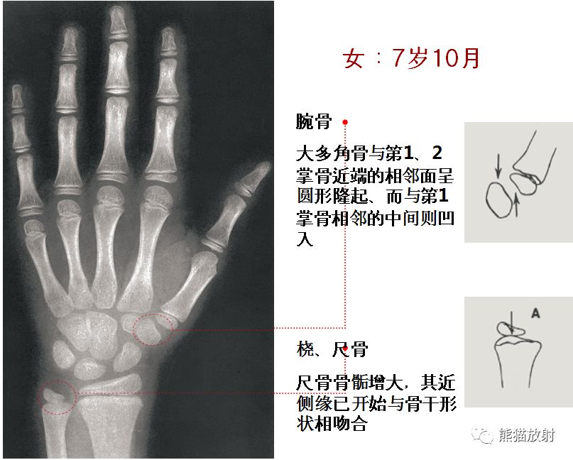 骨龄图谱 骨龄图谱