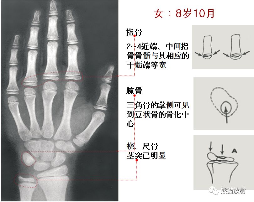 骨龄图谱 骨龄图谱
