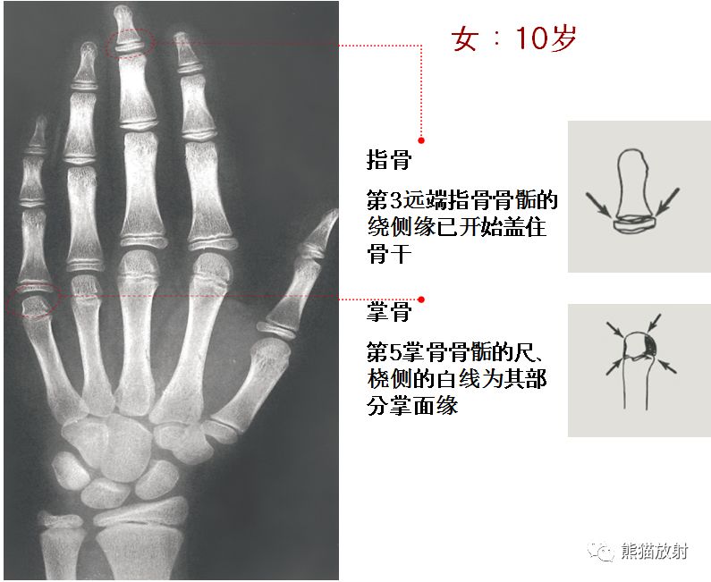 骨龄图谱 骨龄图谱