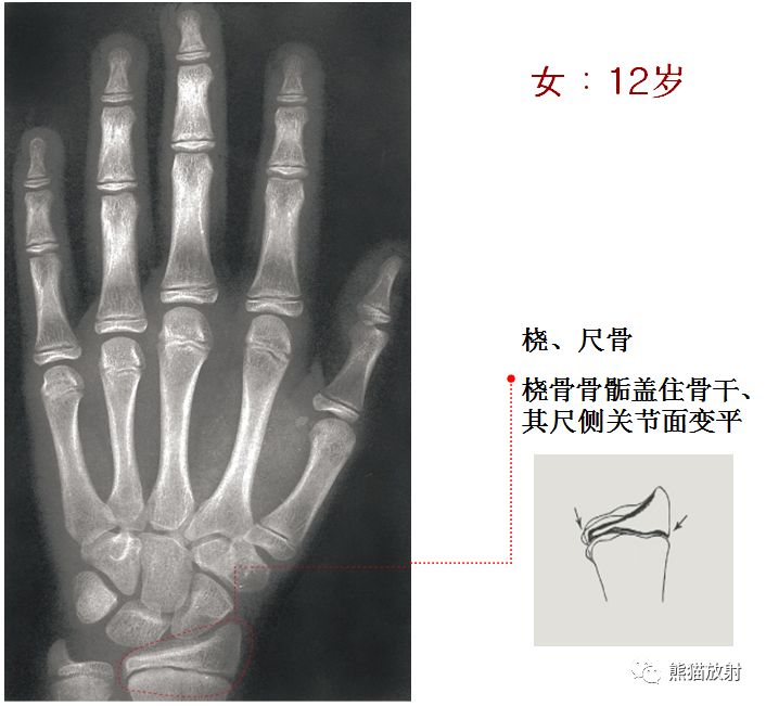 骨龄图谱 骨龄图谱