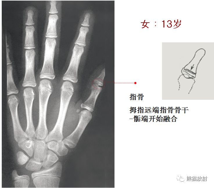 骨龄图谱 骨龄图谱