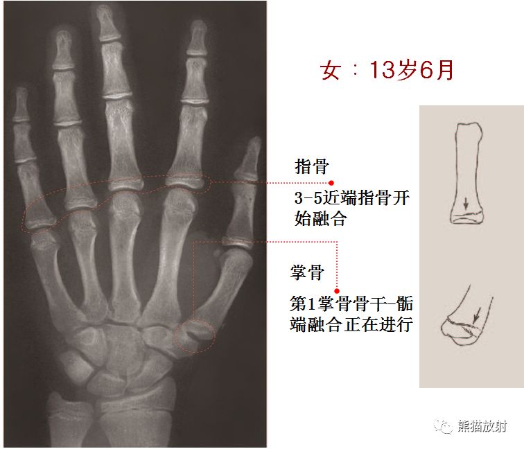 骨龄图谱 骨龄图谱