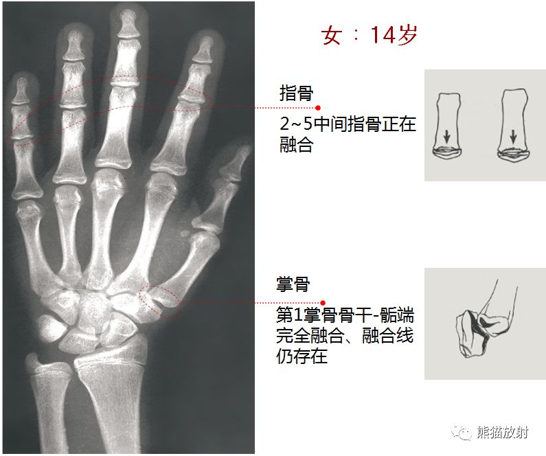 骨龄图谱 骨龄图谱