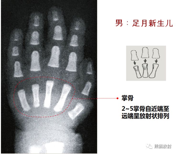 骨龄图谱 骨龄图谱