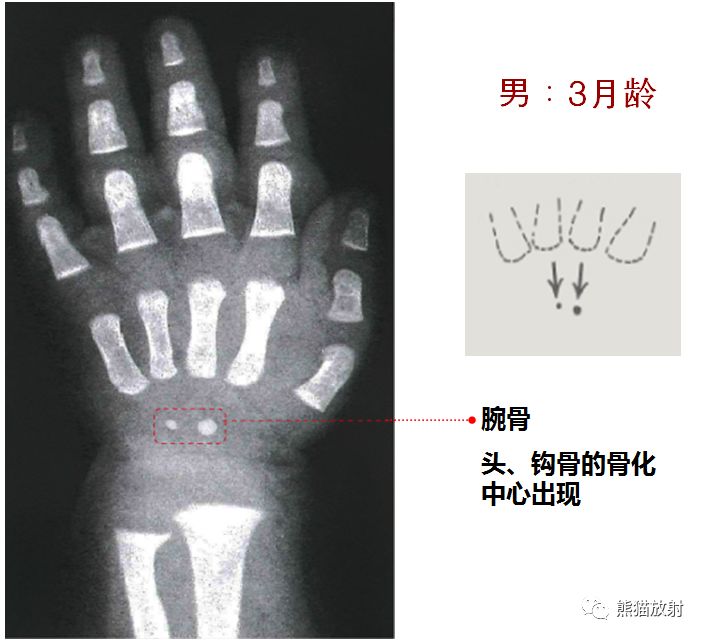 骨龄图谱 骨龄图谱