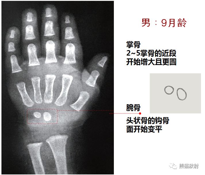 骨龄图谱 骨龄图谱