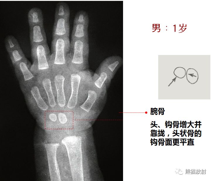 骨龄图谱 骨龄图谱