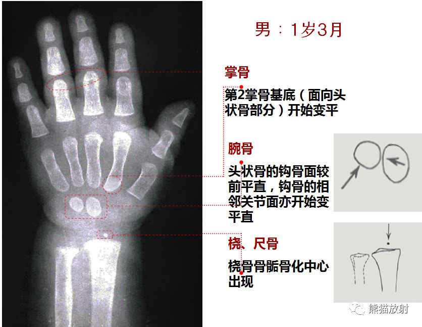 骨龄图谱 骨龄图谱
