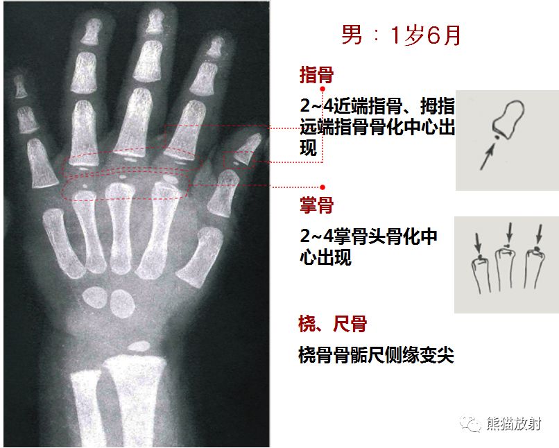 骨龄图谱 骨龄图谱
