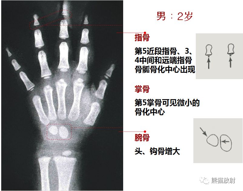 骨龄图谱 骨龄图谱