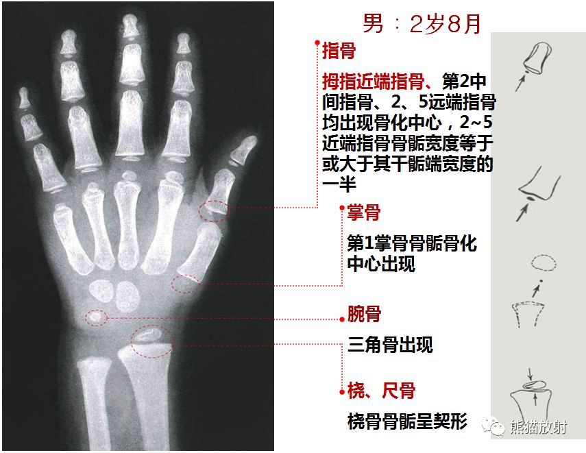 骨龄图谱 骨龄图谱