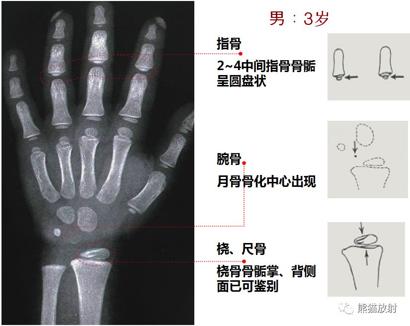 骨龄图谱 骨龄图谱