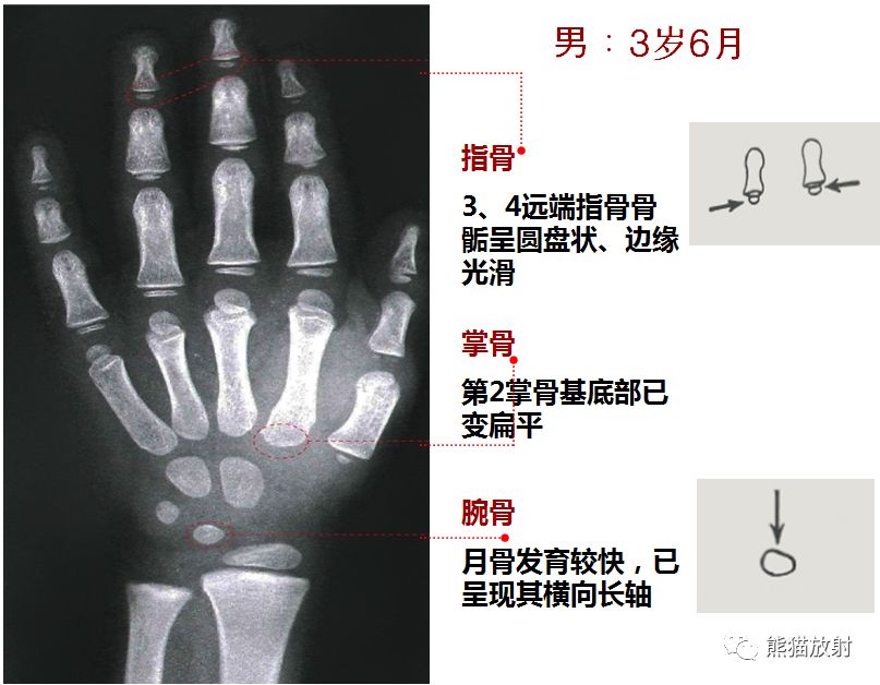 骨龄图谱 骨龄图谱