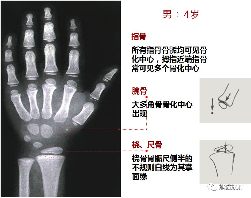 骨龄图谱 骨龄图谱