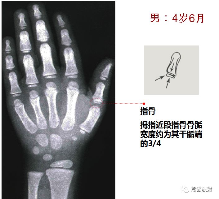 骨龄图谱 骨龄图谱